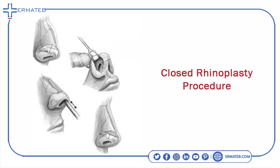 Closed Rhinoplasty Procedure